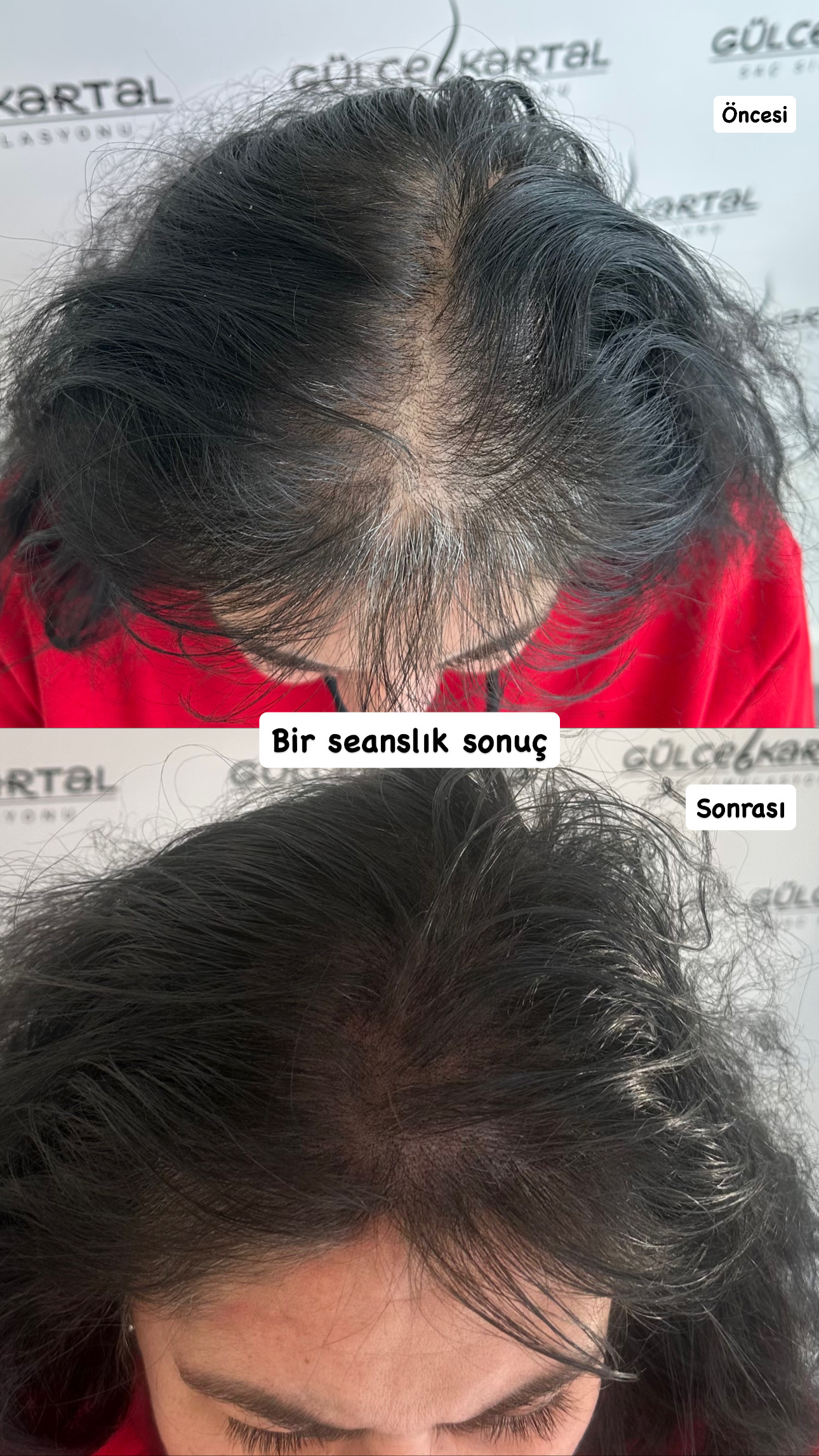 kadınlarda saç simülasyonu