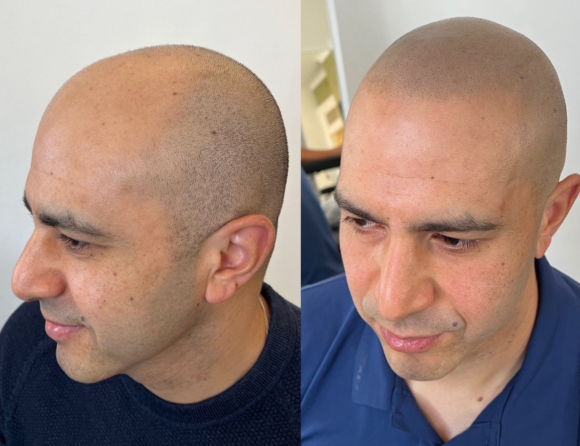 Ana Sayfa smp hair line000