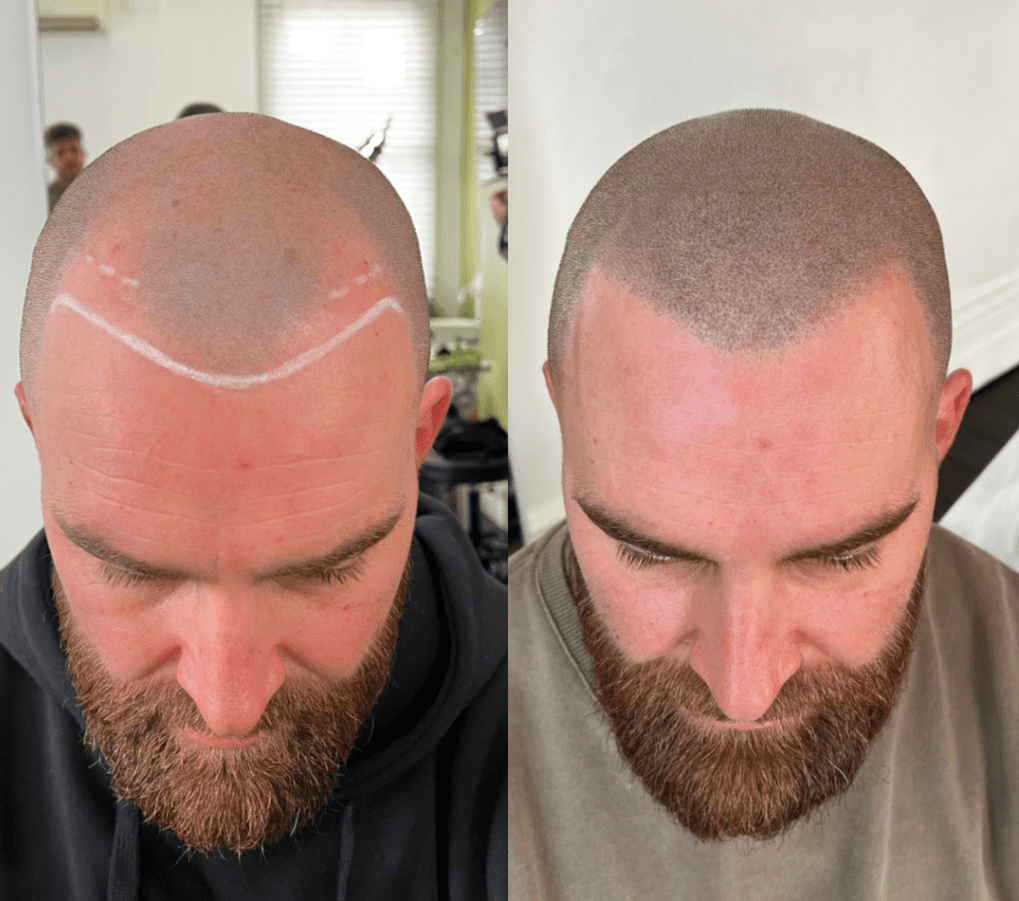 smp hairline 