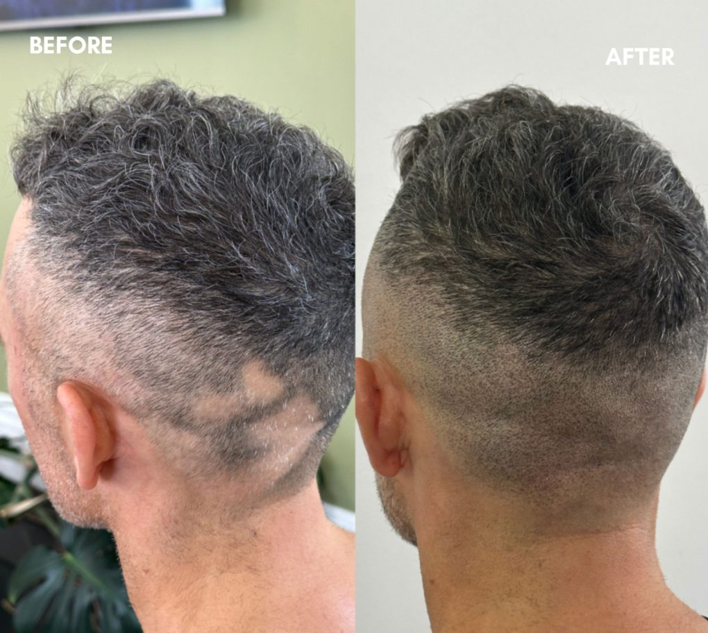 Sonuçlarımız smp 6 alopecia a