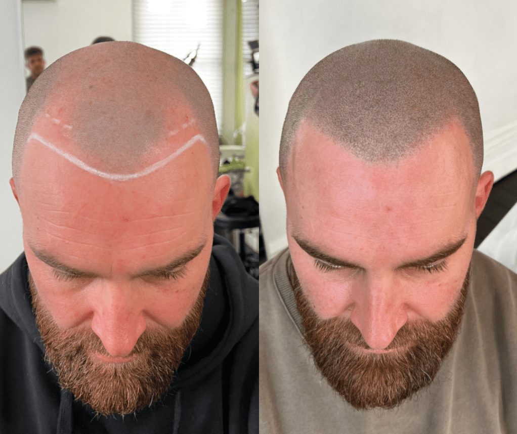 Sonuçlarımız smp hair line 2