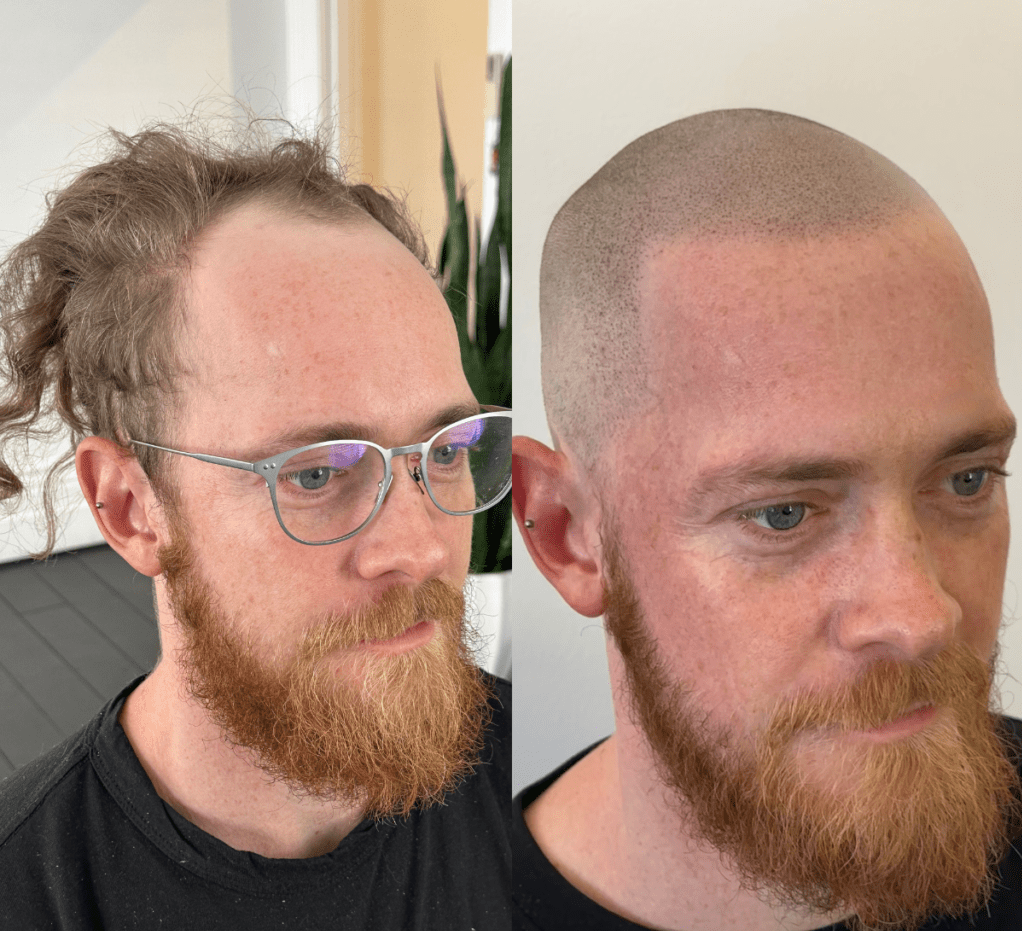 Sonuçlarımız smp hair line 3